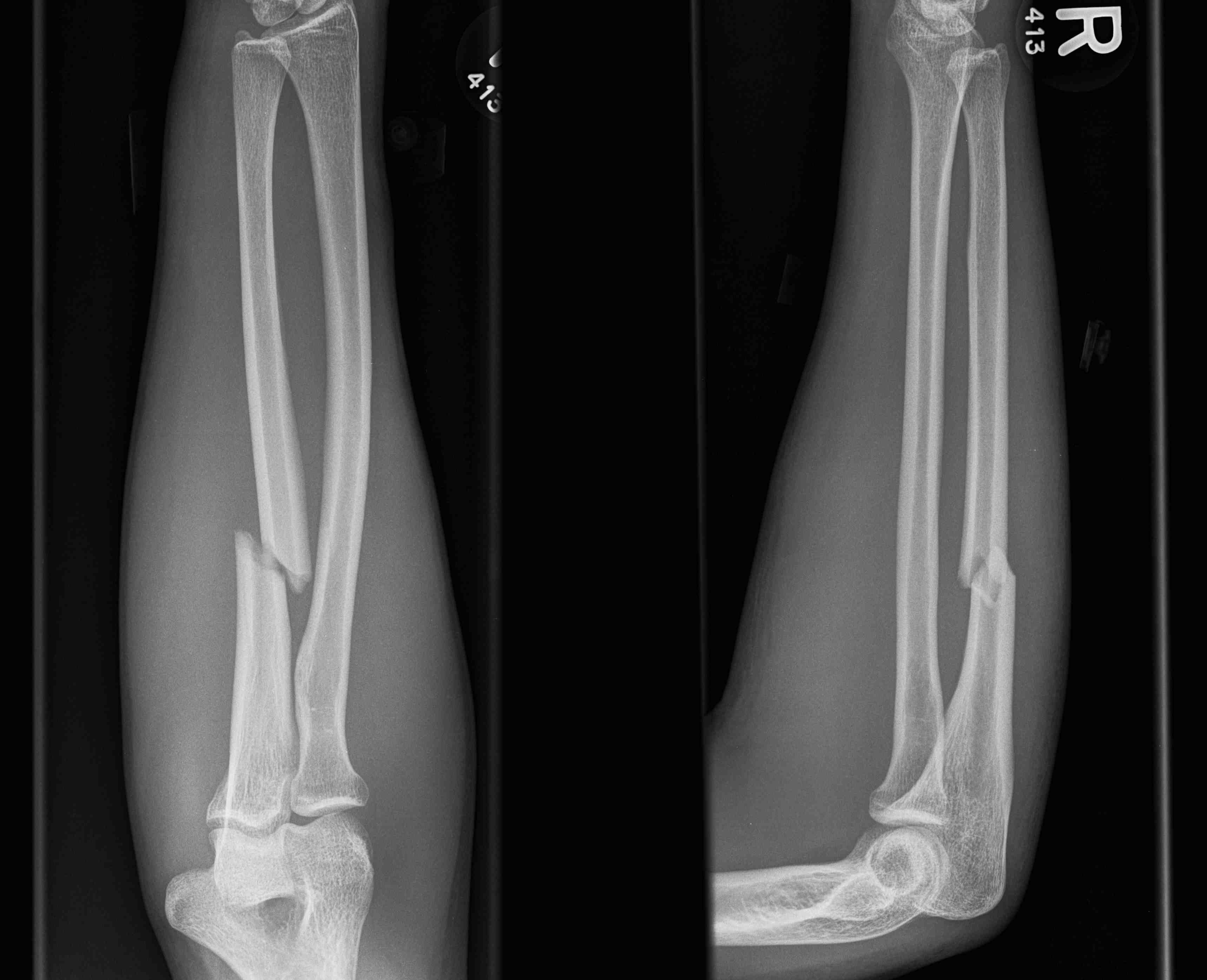 Ulna Fracture Night Stick